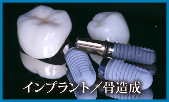 インプラント／骨造成