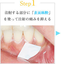 Step1 注射する部分に「表面麻酔」を塗って注射の痛みを抑える